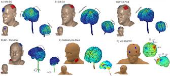 R32_ tES Estimulación Eléctrica Transcraneal